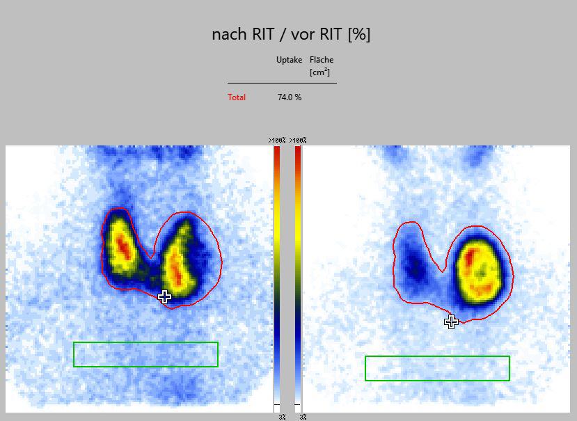 Radioiodtherapie Erfolgskontrolle